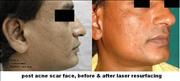 Before After Pictures,Cosmetic surgery,Delhi,face 2 laser, acne scar 